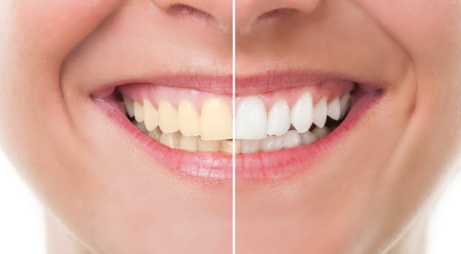 How Does Teeth Whitening Work